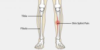 Shin Splints - Treatment & Prevention