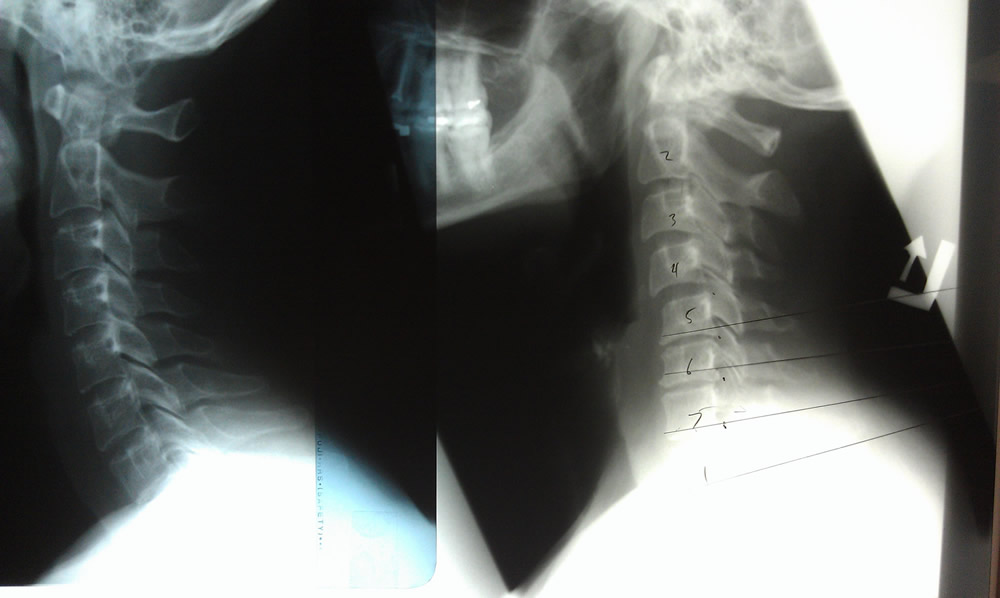 Normal Vs Arthritis – C7 is the subluxated vertebra with degenerative arthritis directly above (C4-7)